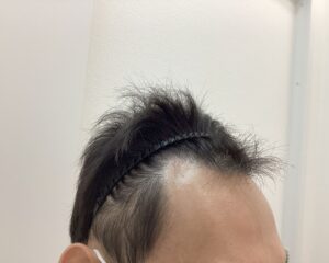 AGA治療前 35歳男性 生え際の薄毛 新潟院