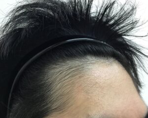 AGA治療後＿22歳男性＿生え際の改善＿大阪梅田院