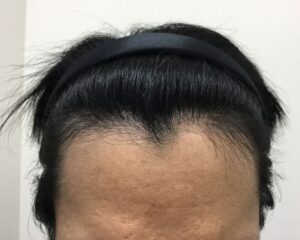 AGA治療後＿41歳男性＿生え際と頭頂部の改善＿大阪梅田院