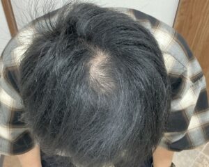 AGA治療後＿41歳男性＿生え際と頭頂部の改善＿広島院