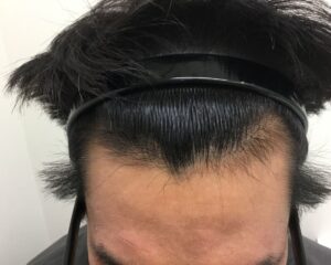AGA治療後＿40歳男性＿生え際と頭頂部の改善＿大阪梅田院
