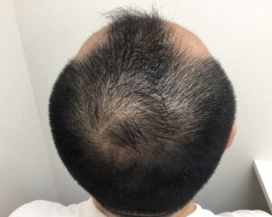 AGA治療後＿46歳男性＿生え際と頭頂部の改善＿大阪梅田院