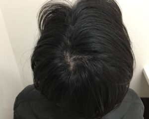 AGA治療後＿28歳男性＿生え際・頭頂部改善＿大阪梅田院