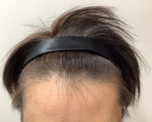 AGA治療後＿30歳男性＿生え際・頭頂部の改善＿広島院