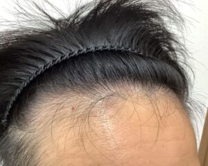 AGA治療後＿23歳男性＿生え際と頭頂部の改善＿広島院