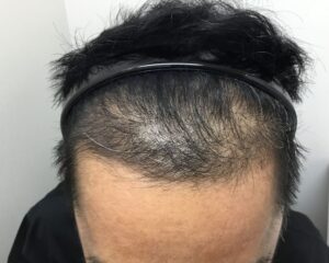 AGA治療後_53歳男性_生え際と頭頂部の改善_大阪梅田院