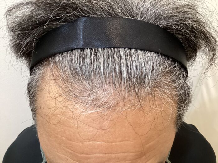 AGA治療後_54歳男性_生え際の改善_広島院
