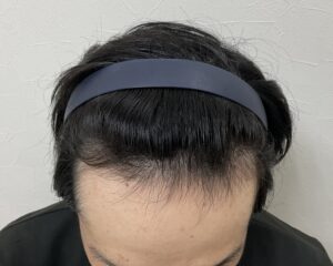 AGA治療9ヵ月後　29歳男性　生え際・頭頂部薄毛　岡山院