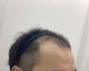 AGA治療5ヵ月後　30歳男性　前頭・頭頂部改善　新潟院