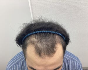AGA治療5ヵ月後　30歳男性　前頭・頭頂部改善　新潟院