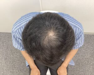 AGA治療5ヵ月後　30歳男性　前頭・頭頂部改善　新潟院