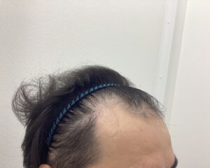 AGA治療1年6ヵ月後　30歳男性　前頭・頭頂部改善　新潟院