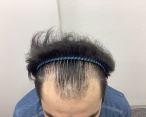 AGA治療1年6ヵ月後　30歳男性　前頭・頭頂部改善　新潟院