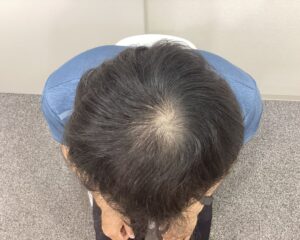 AGA治療1年6ヵ月後　30歳男性　前頭・頭頂部改善　新潟院