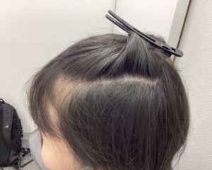 FAGA8ヵ月後　24歳女性　生え際・分け目改善　新潟院