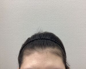FAGA8ヵ月後　24歳女性　生え際・分け目改善　新潟院
