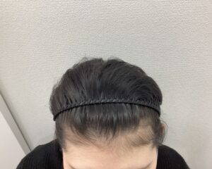 FAGA8ヵ月後　24歳女性　生え際・分け目改善　新潟院