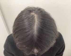 FAGA8ヵ月後　24歳女性　生え際・分け目改善　新潟院