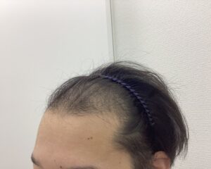AGA治療1年後　32歳男性　前頭・頭頂部改善中　新潟院