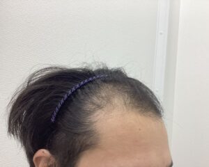 AGA治療1年後　32歳男性　前頭・頭頂部改善中　新潟院