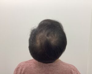 AGA治療3ヶ月後　43歳男性　生え際・頭頂部改善中　新潟院