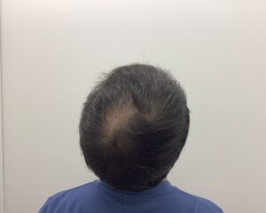 AGA治療約1年後　43歳男性　生え際・頭頂部改善中　新潟院