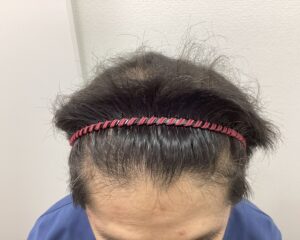 AGA治療約1年後　43歳男性　生え際・頭頂部改善中　新潟院