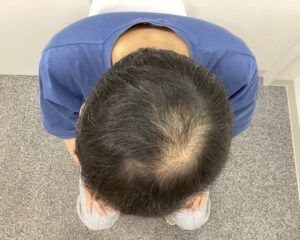 AGA治療約1年後　43歳男性　生え際・頭頂部改善中　新潟院