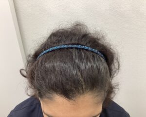 FAGA1年後　42歳女性　側頭部・頭頂部改善中　新潟院