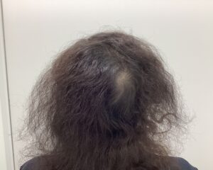FAGA1年後　42歳女性　側頭部・頭頂部改善中　新潟院