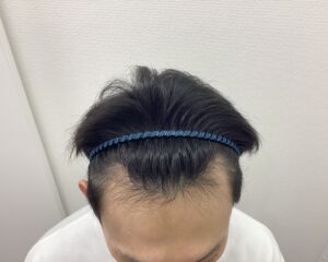 AGA治療4ヵ月半後 35歳男性 生え際改善 新潟院
