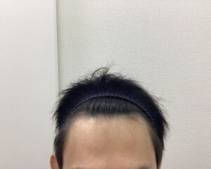 AGA治療7ヵ月半後 35歳男性 生え際改善 新潟院