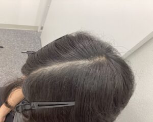 AGA治療8ヵ月後 29歳男性 前頭・頭頂部改善 新潟院