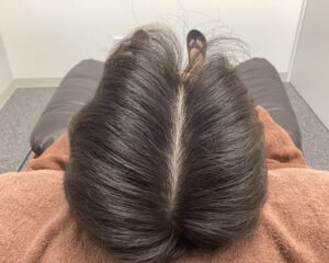 AGA治療8ヵ月後 29歳男性 前頭・頭頂部改善 新潟院