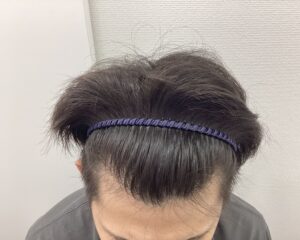 AGA治療8ヵ月後 29歳男性 前頭・頭頂部改善 新潟院