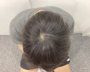 AGA治療8ヵ月後 29歳男性 前頭・頭頂部改善 新潟院