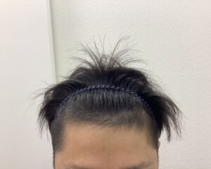 AGA治療4ヶ月後　31歳男性　生え際改善中　新潟院