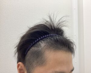 AGA治療4ヶ月後　31歳男性　生え際改善中　新潟院