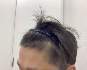 AGA治療4ヶ月後　31歳男性　生え際改善中　新潟院