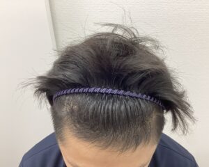 AGA治療4ヶ月後　31歳男性　生え際改善中　新潟院