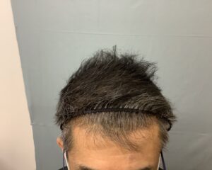 AGA治療前　43歳男性　生え際・頭頂部薄毛　金沢院
