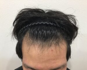 AGA治療前　28歳男性　生え際薄毛　千葉津田沼院