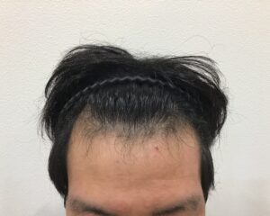 AGA治療前　28歳男性　生え際薄毛　千葉津田沼院