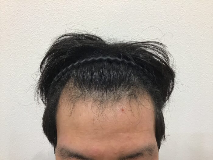 【28歳男性】生え際の薄毛がAGA治療で改善｜千葉津田沼院