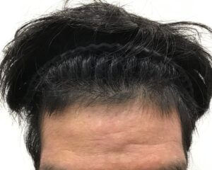 AGA治療3ヶ月後　28歳男性　生え際薄毛　千葉津田沼院