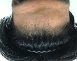 AGA治療6ヶ月後　28歳男性　生え際薄毛改善　千葉津田沼院