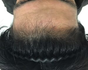 AGA治療6ヶ月後　28歳男性　生え際薄毛改善　千葉津田沼院
