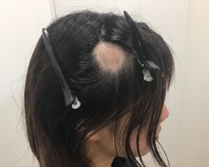 単発型円形脱毛症治療前　26歳女性　側頭部　単発型円形脱毛　千葉津田沼院