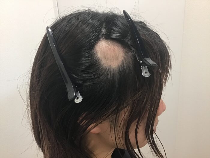【26歳女性】単発型円形脱毛症がメソセラピー治療で改善｜千葉津田沼院