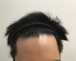AGA治療前　32歳男性　生え際薄毛　千葉津田沼院